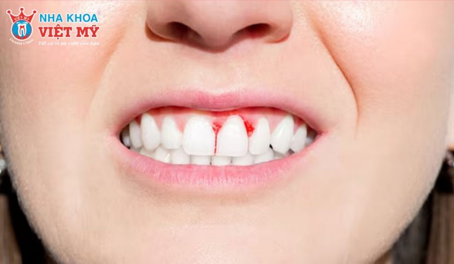 Thường xuyên chảy máu chân răng có nguy hiểm đến sức khỏe không?