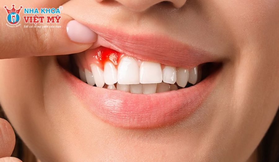 Chảy máu chân răng là bệnh gì? 