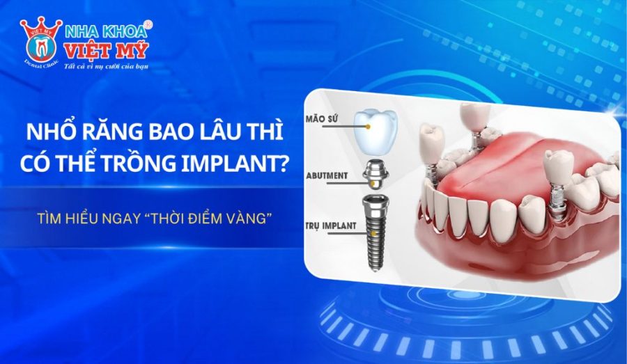 Nhổ răng bao lâu thì trồng Implant hiệu quả?
