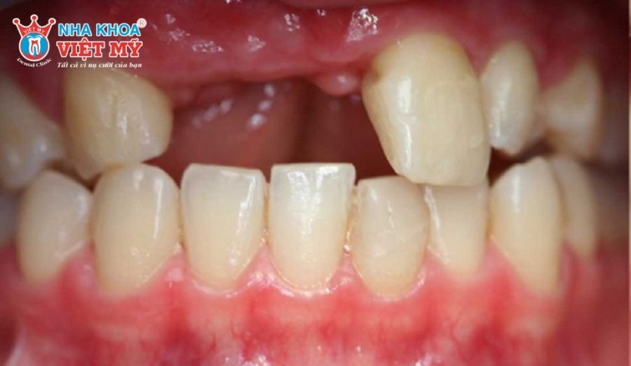 Thời điểm nào phù hợp nhất để trồng Implant sau khi nhổ răng?