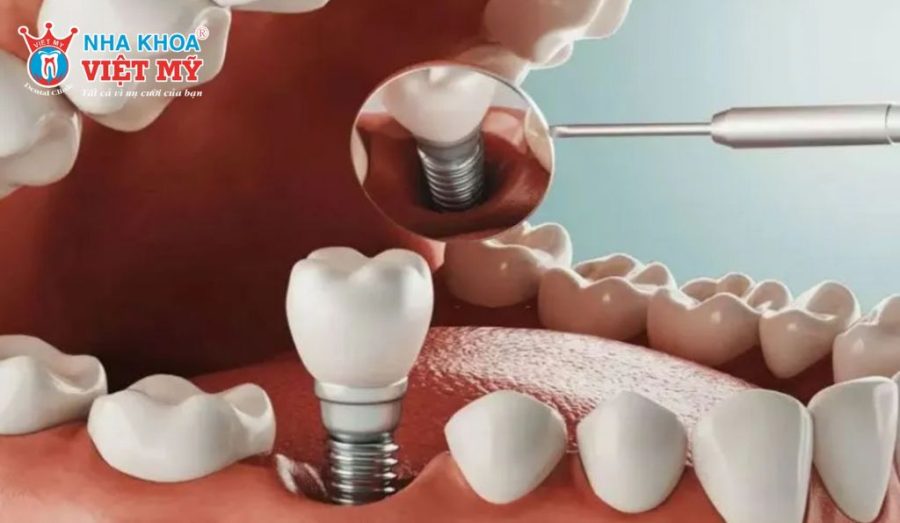 Sau khi nhổ răng có nhiều thời điểm có thể phục hình Implant.