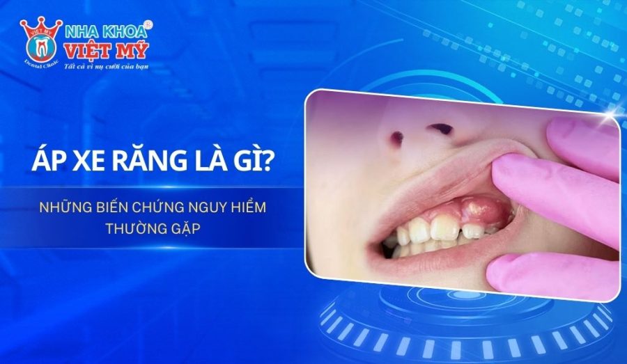 Áp xe răng là gì?