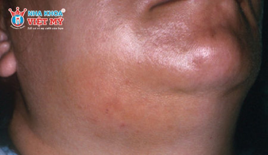 Viêm mô lan tỏa là biến chứng nguy hiểm khi bị áp xe răng