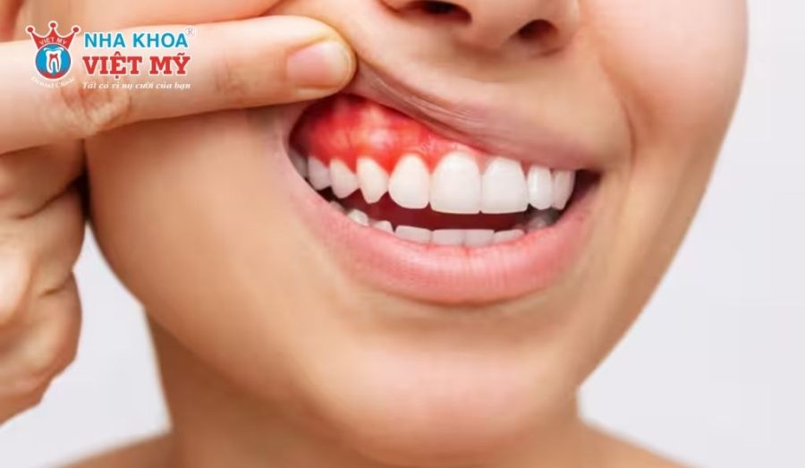 Áp xe răng là gì?