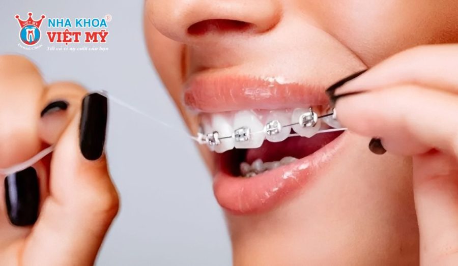 Cách sử dụng chỉ nha khoa cho người đang niềng răng