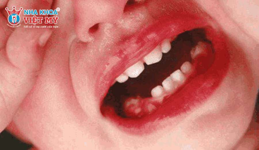 Những dấu hiệu thường nhầm lẫn với mọc răng ở trẻ nhỏ