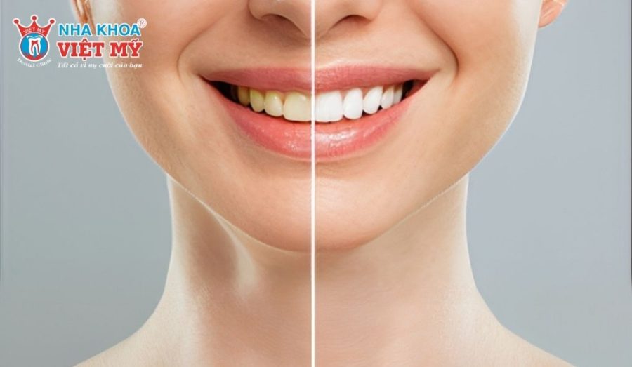 Tẩy trắng răng là gì?
