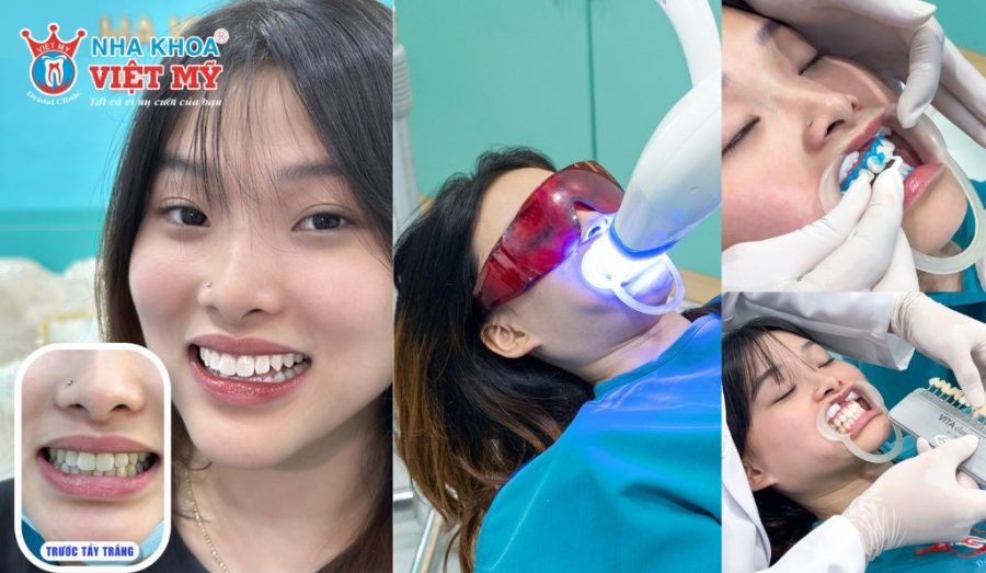 Hình ảnh trước và sau của khách hàng khi tẩy trắng răng tại Nha khoa Việt Mỹ