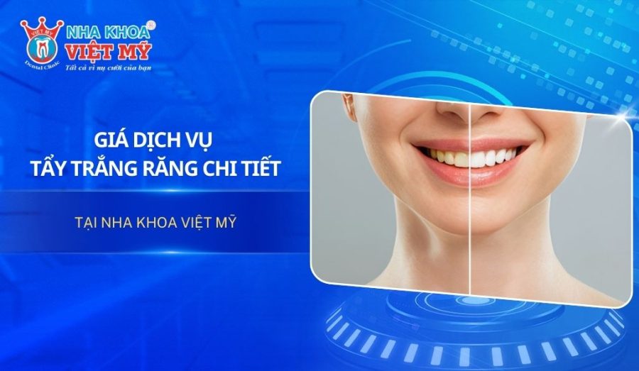 Giá dịch vụ tẩy trắng răng tại Nha khoa Việt Mỹ