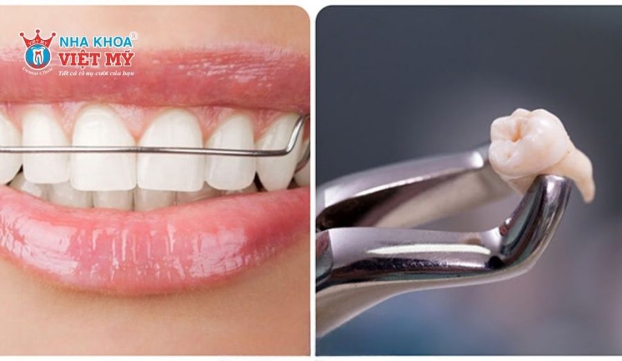 Nhổ răng khôn khắc phục tình trạng chạy răng sau niềng