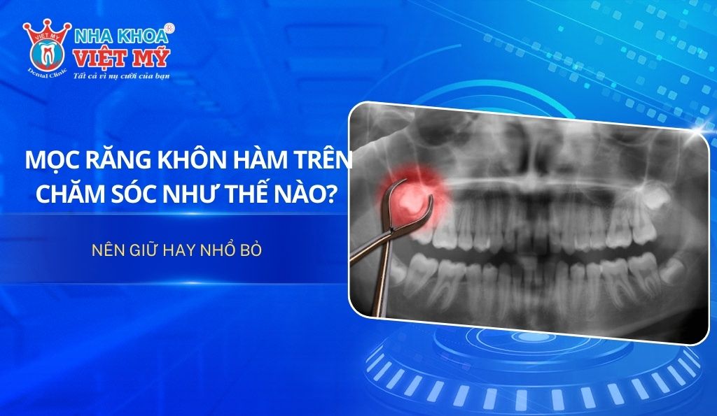 Mọc răng khôn hàm trên chăm sóc như thế nào? Nên giữ hay nhổ bỏ