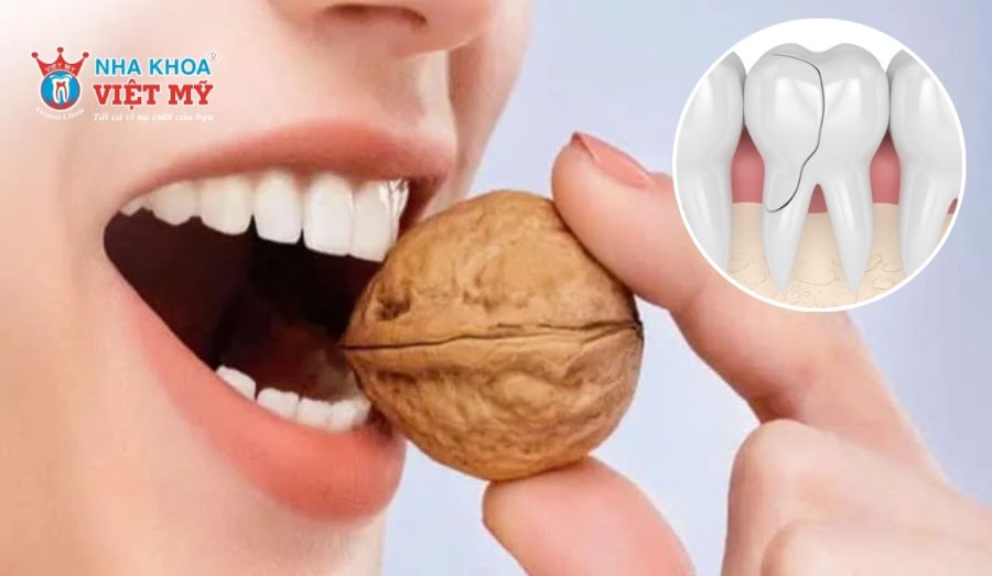 Răng bị vỡ dọc do thói quen ăn đồ quá cứng