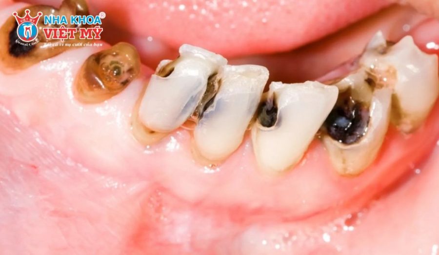 Viêm tủy răng có nguy hiểm không