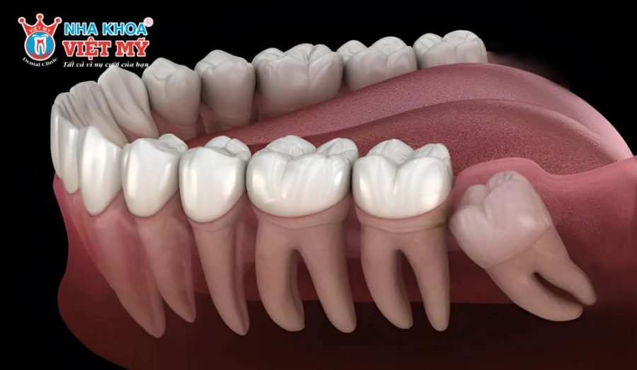 Nhổ răng khôn khi nào cần thực hiện và bao lâu thì lành