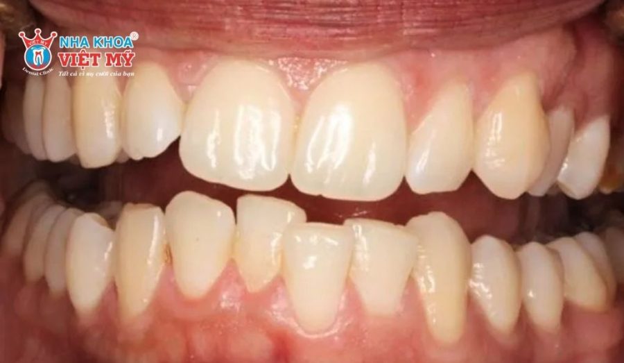 Răng bị chạy sau khi tháo niềng