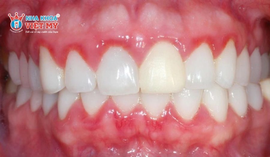 Răng sứ bị đau nhức, viêm lợi cần tháo ra bọc lại