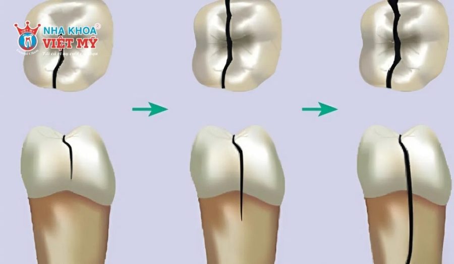 Răng bị vỡ có thể dẫn tới đau nhức, nhiễm trùng hoặc mất răng