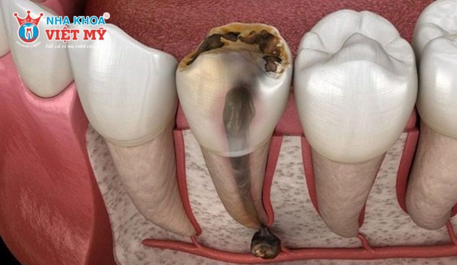 Viêm tủy răng là bệnh gì