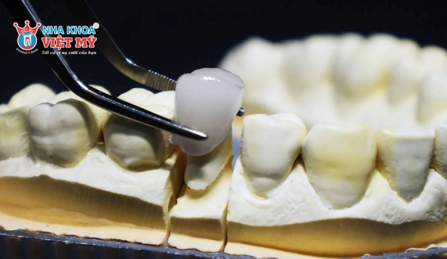 Tháo răng sứ không gây đau đớn