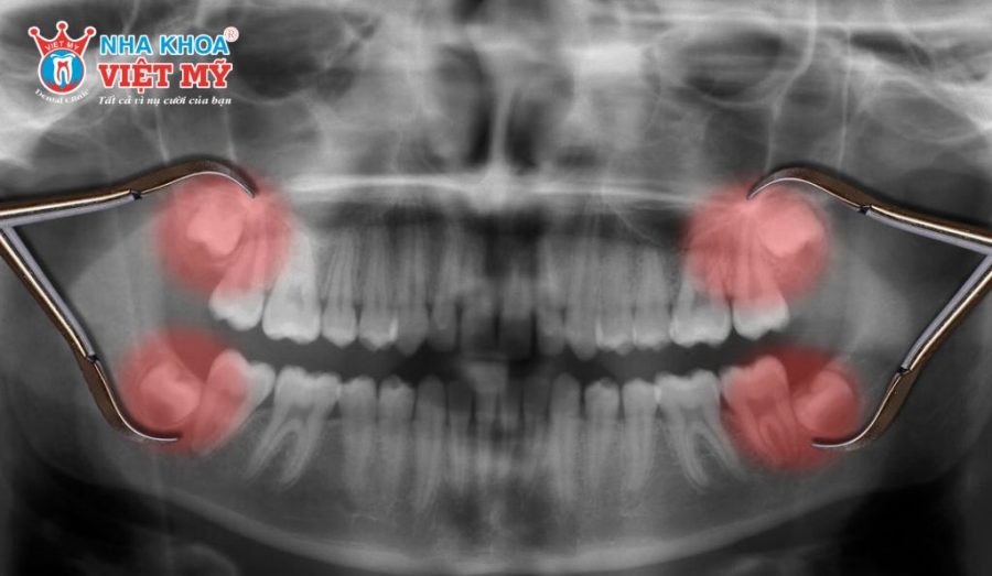 Yếu tố ảnh hưởng đến quá trình lành thương sau khi nhổ răng khôn