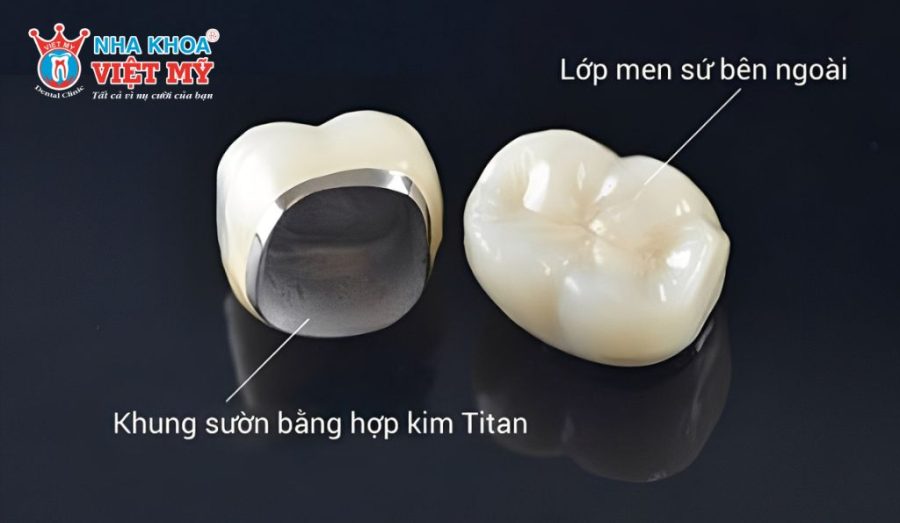 Răng sứ Titan là gì?