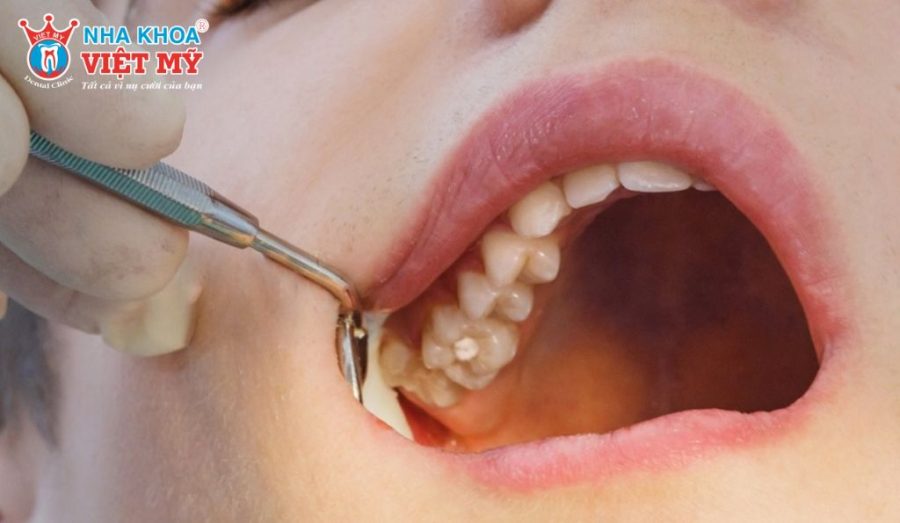 Nguyên nhân mọc răng khôn hàm trên gây khó chịu