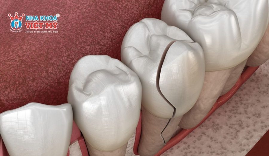 Răng bị vỡ dọc không thể tự phục hồi