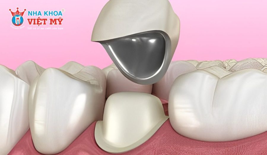 Răng sứ Titan có tuổi thọ trung bình từ 5 - 15 năm