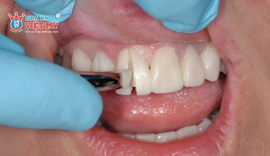 Quy trình tháo răng sứ được thực hiện nhẹ nhàng, chuẩn y khoa