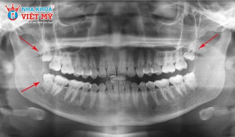 Mọc răng khôn hàm trên có nguy hiểm không
