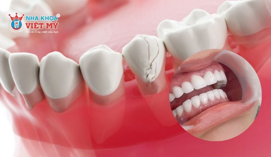 Bọc sứ phù hợp với vết nứt lớn nhưng chưa ảnh hưởng tủy