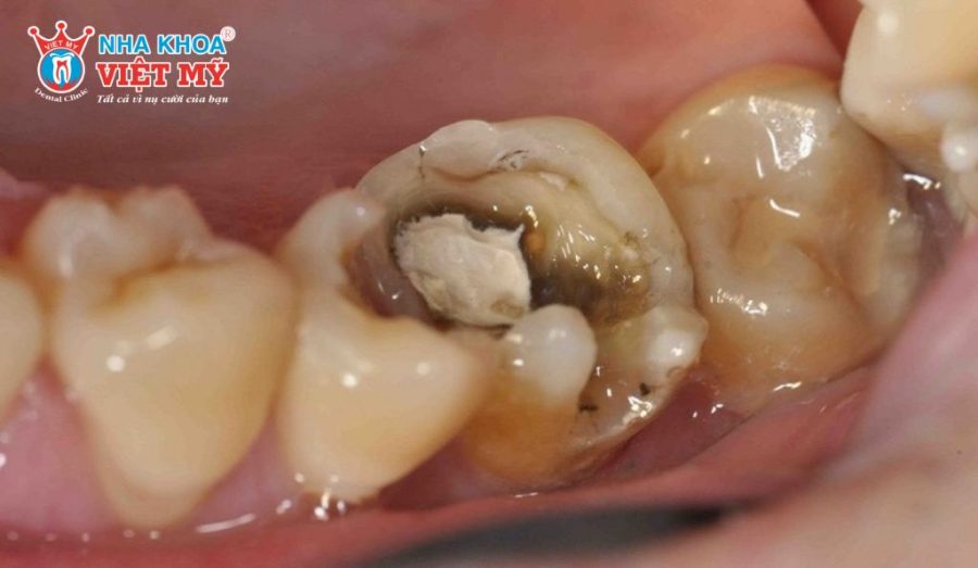 Viêm tủy răng là bệnh gì
