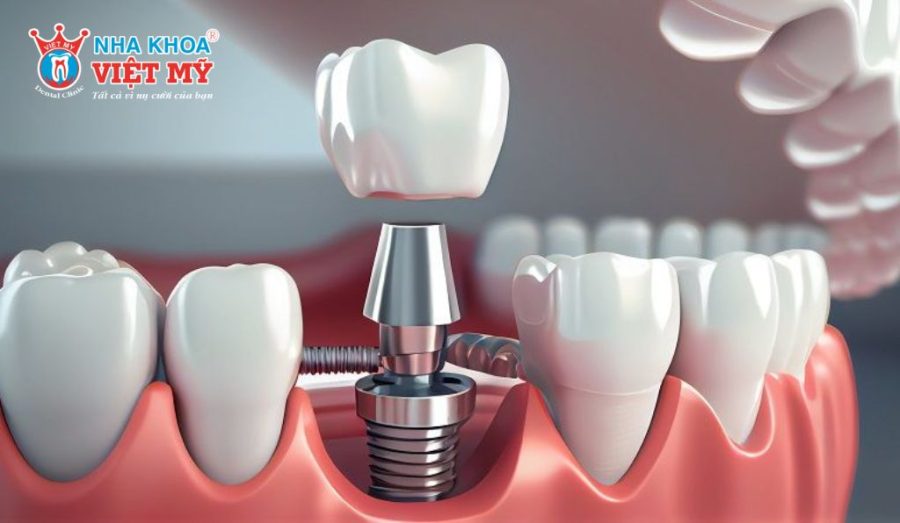 So sánh răng sứ Titan với các loại răng sứ khác
