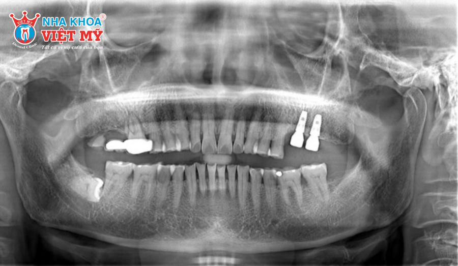 Những trường hợp cần trồng Implant