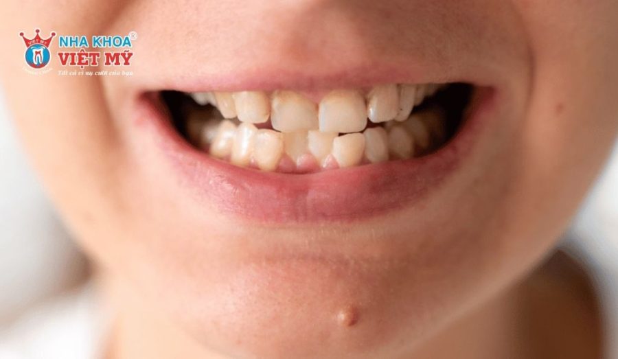 Dấu hiệu phổ biến giúp nhận biết răng bị chạy sau niềng