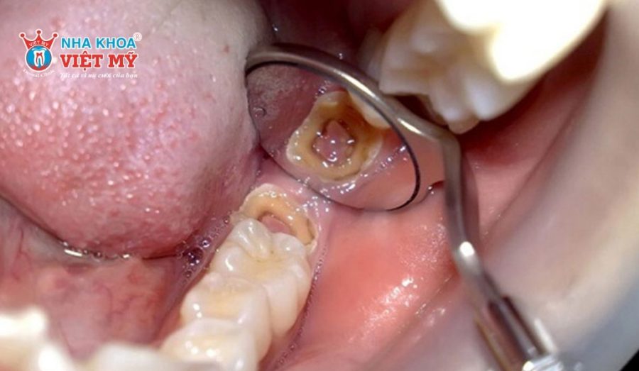 Răng khôn rất dễ bị tích tụ mảng bám và vi khuẩn