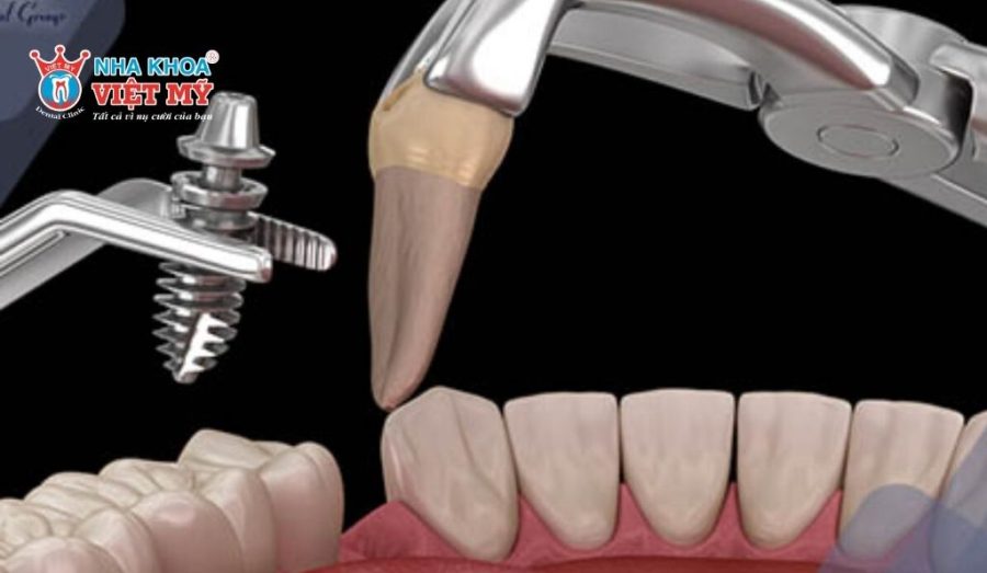 Vết nứt đã lan sâu cần nhổ răng và trồng răng Implant