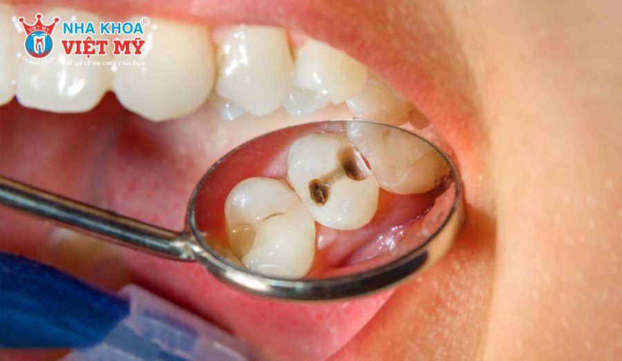 Phân loại viêm tủy răng