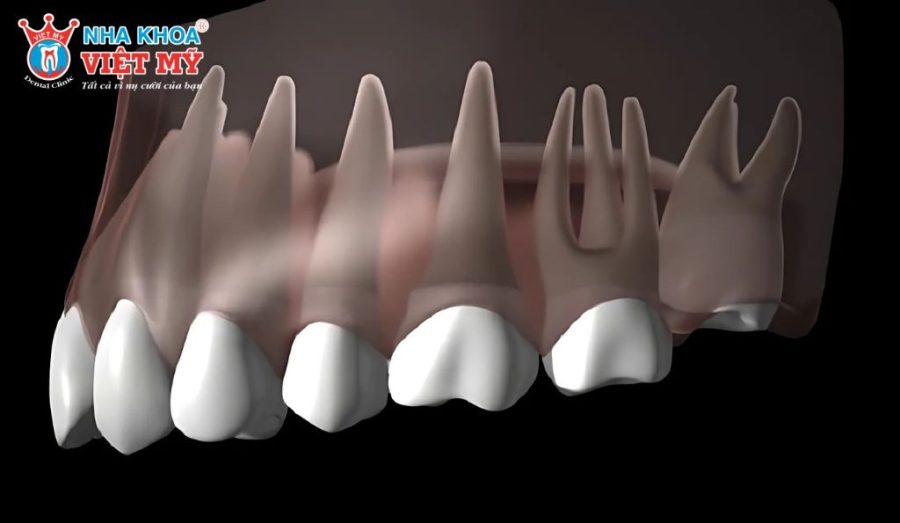 Răng khôn hàm trên mọc khi nào?