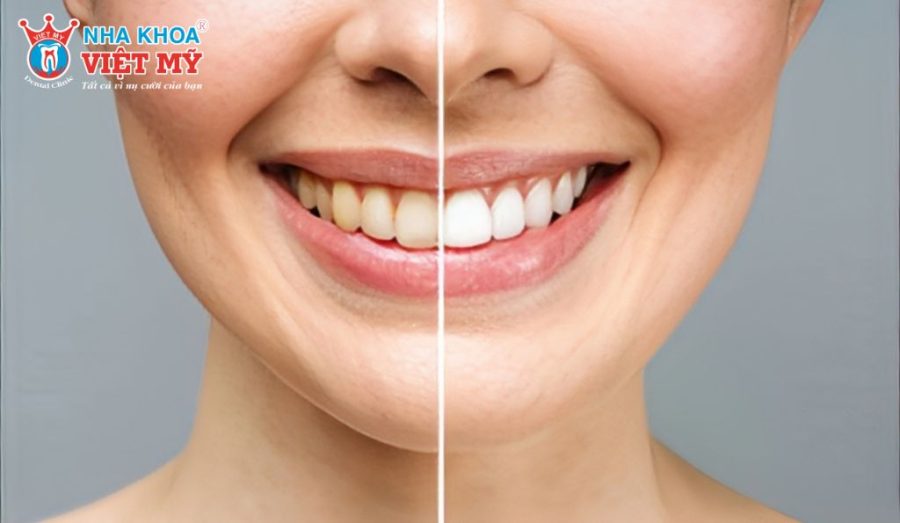 Tác dụng phụ của nước súc miệng là làm xỉn màu, ố vàng răng