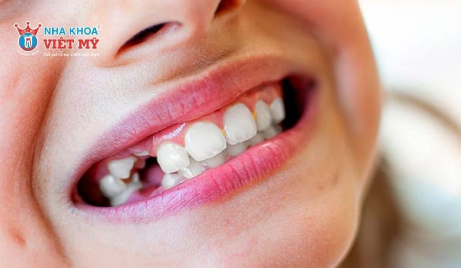 Răng bị vỡ dọc có thể gây mất răng vĩnh viễn