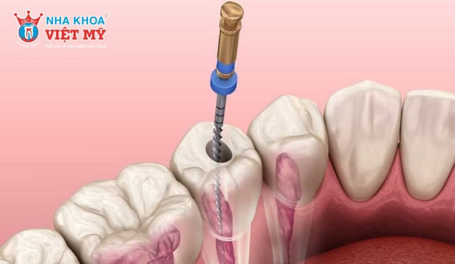 Các phương pháp điều trị viêm tủy răng tại nha khoa