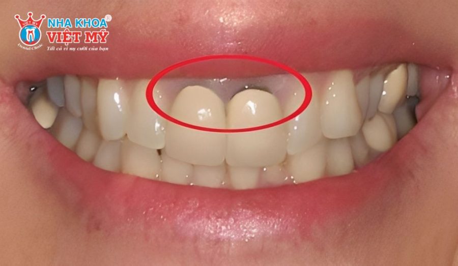 Răng sứ Titan bị đen viền nướu sau thời gian dài sử dụng