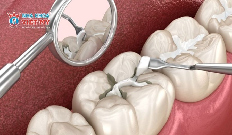 Trám răng áp dụng cho vết nứt nhỏ