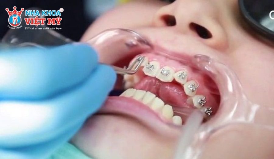Lưu ý quan trọng rút ngắn thời gian niềng răng