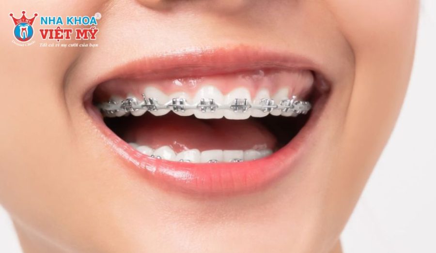Những yếu tố ảnh hưởng tới quá trình niềng răng