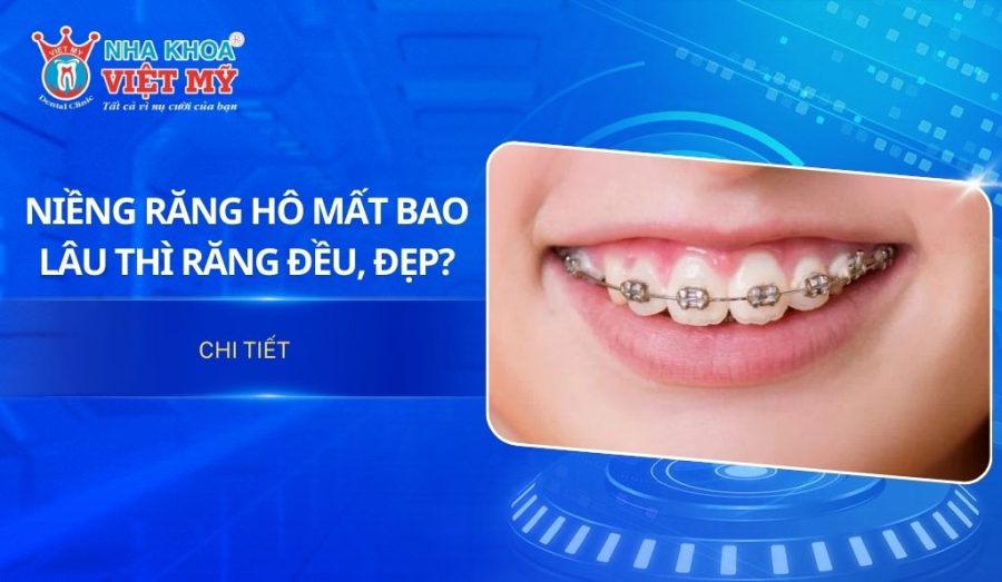 Niềng răng hô mất bao lâu thì răng đều đẹp?