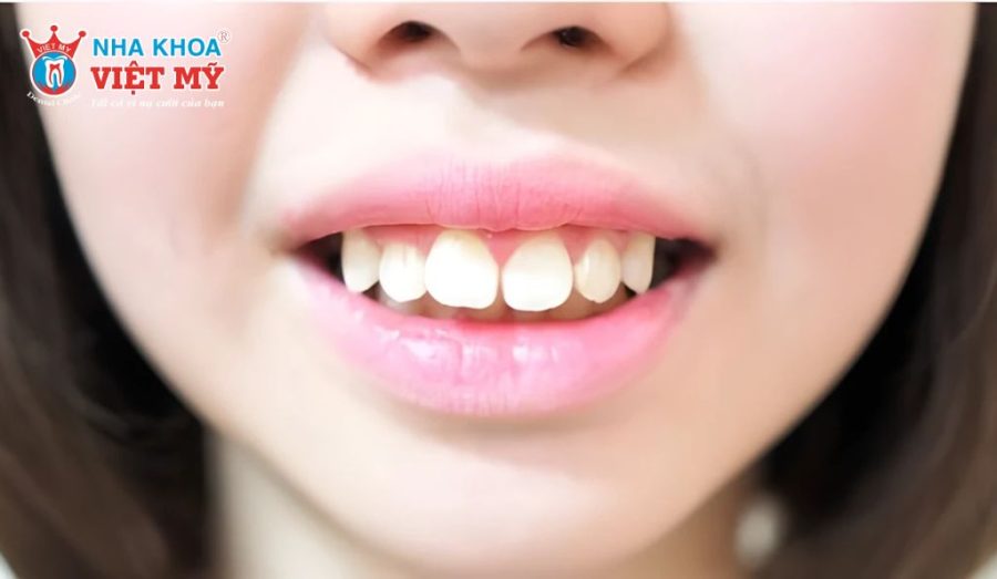 Niềng răng hô mất bao lâu để vừa đẹp vừa hiệu quả