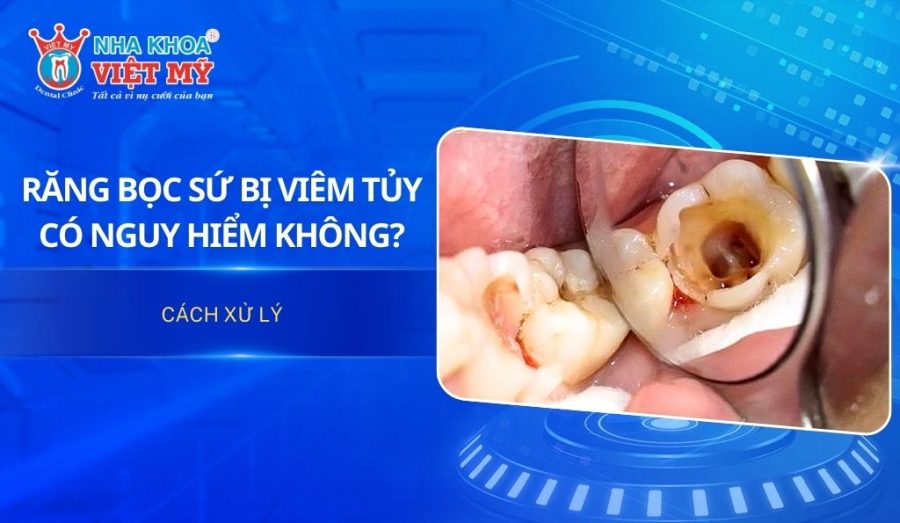 Răng bọc sứ bị viêm tủy có nguy hiểm không? Cách xử lý