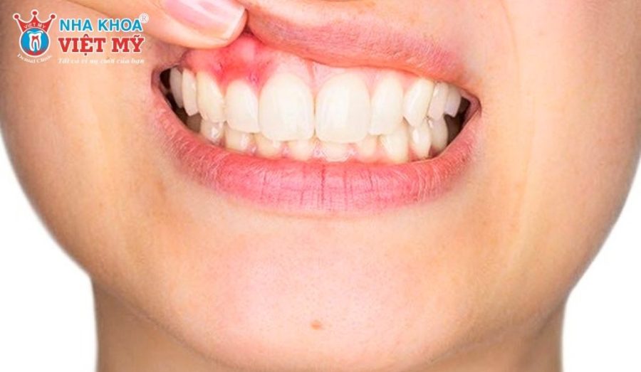 Nguyên nhân nào dẫn đến tình trạng viêm tủy sau khi bọc sứ?